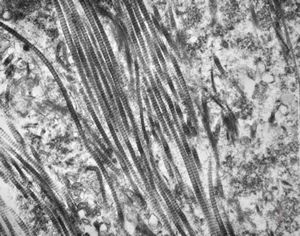 F, 45y. | necrobiosis lipoidica